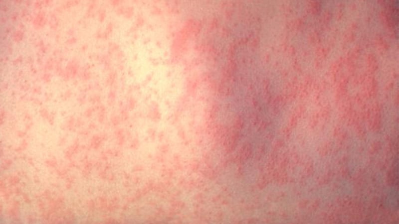 Measles