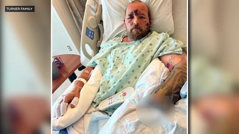 A California man lost his hand after picking up an explosive device during a Fourth of July...